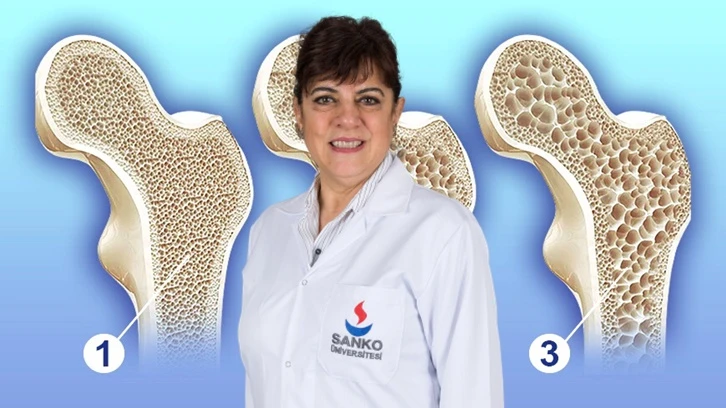 Gizli tehlike: Osteoporoz