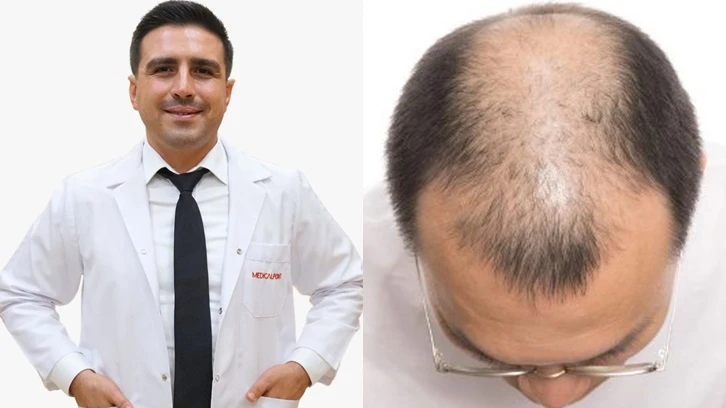 Saç dökülmesi ciddi hastalıkların habercisi olabilir!