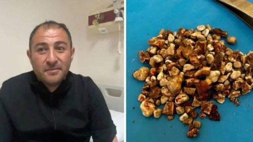 Böbreklerinden 300'ü aşkın taş çıktı: 'Hatırası var' deyip evine götürdü