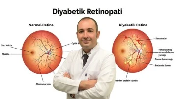 Diyabetik retinopati körlük ile sonuçlanabilir!