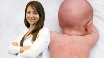 Egzama &ccedil;oğunlukla erken &ccedil;ocukluk d&ouml;neminde başlıyor