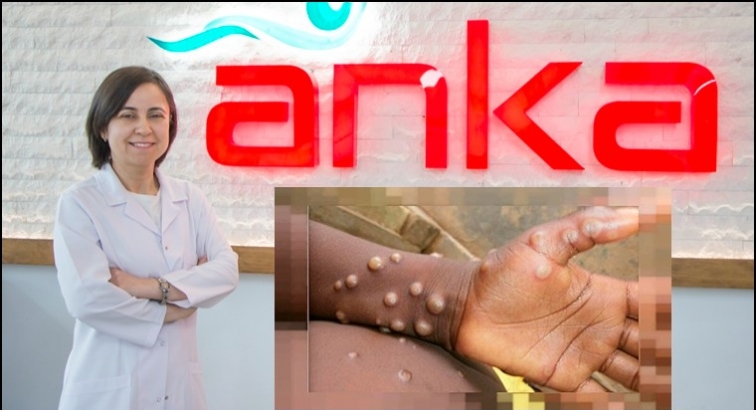 Maymun &Ccedil;i&ccedil;eği vir&uuml;s&uuml; hızla yayılıyor!