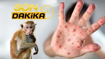 Maymun çiçeği virüsü için ‘küresel acil durum’ ilan edildi