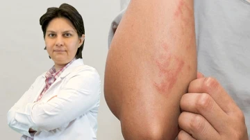 &Uuml;rtiker hastalığının tedavisi m&uuml;mk&uuml;n m&uuml;?