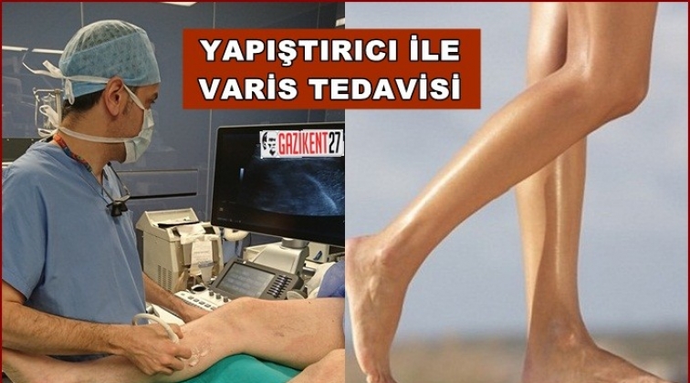 Yapıştırıcı ile varis tedavisi